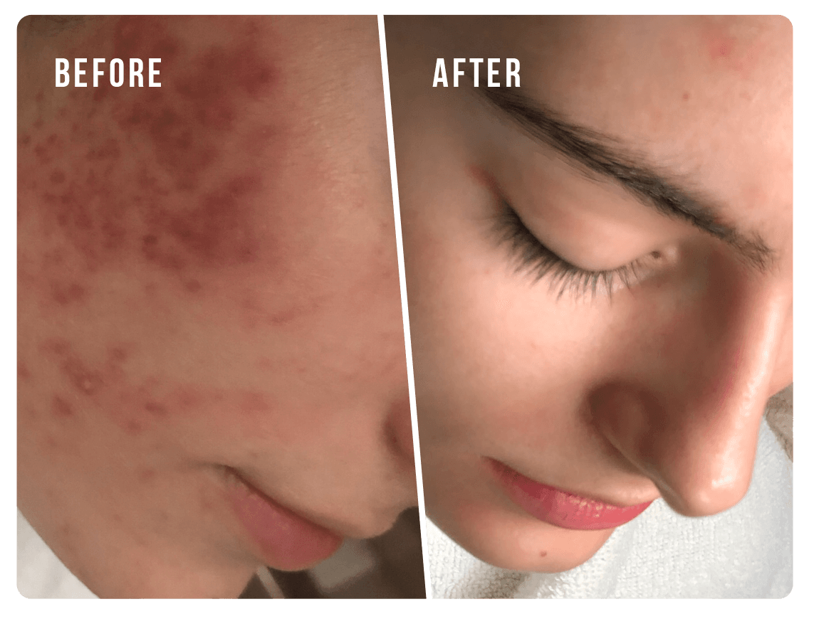 Hormonal Acne