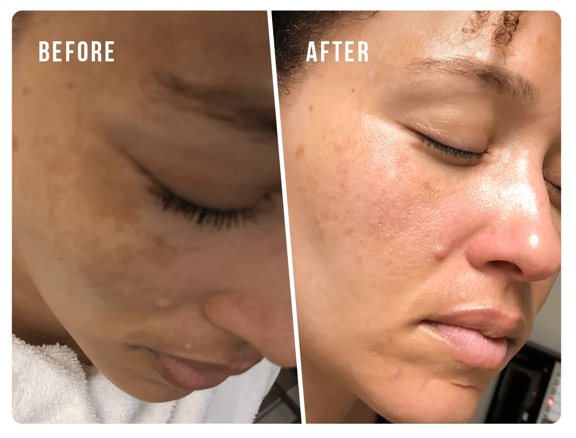 Pigmentation