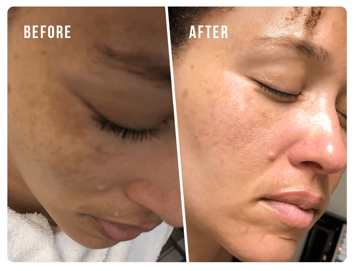Pigmentation